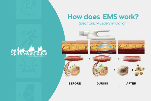 EMS treatment for post pregnancy weight loss treatment Braintree