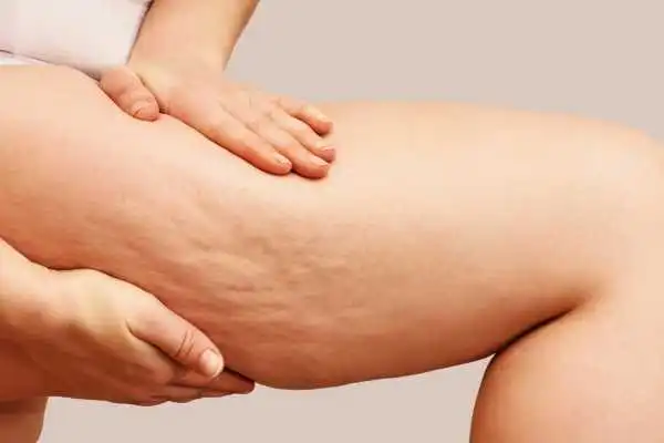 Image of woman showing leg with cellulite Braintree