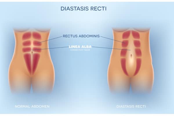 What Non-Surgical Options Are Available for Diastasis Recti Braintree?