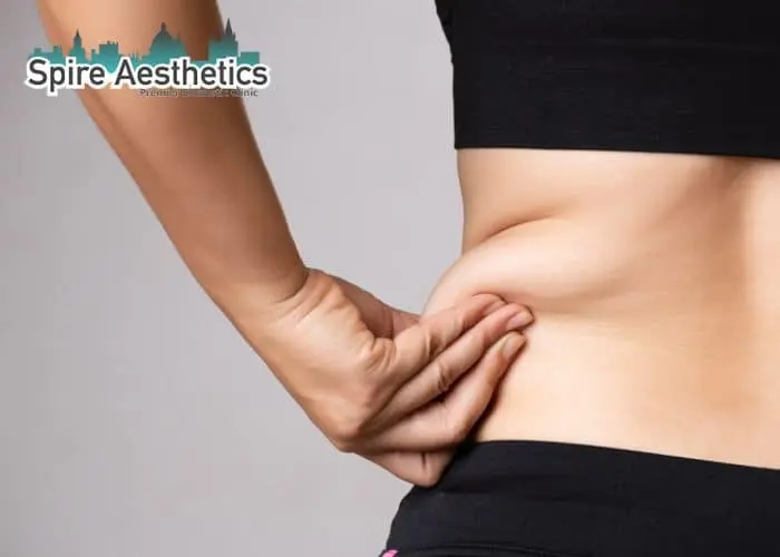 Image of woman pinching fat on their hips Braintree. Fat Freezing treatment
