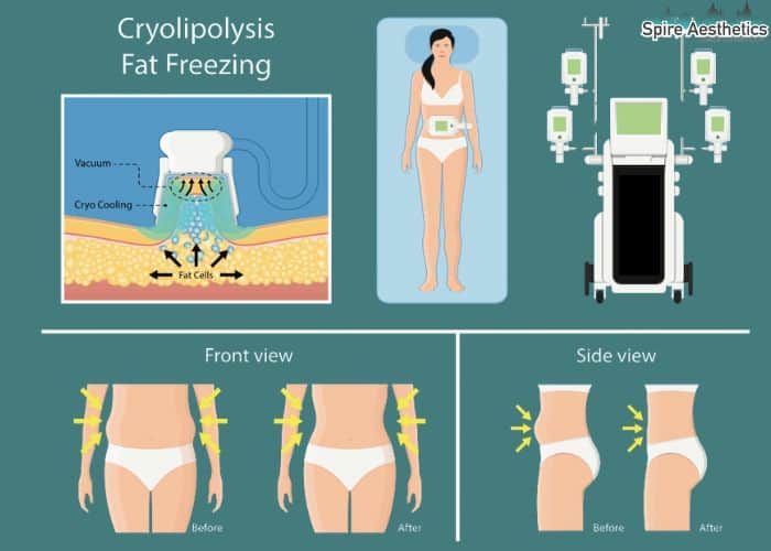Image of diet and fat freezing combined for best results for Spire Aesthetics Braintree