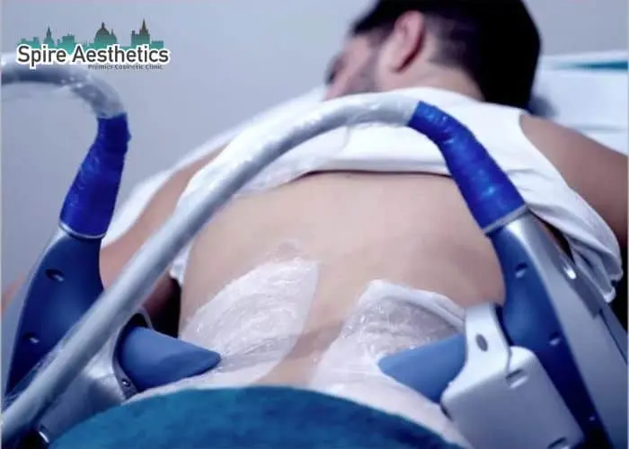 Man having fat freezing treatment done on love handles before a competitions Braintree to create a sculpted look.