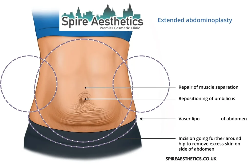 Understanding Loose Skin After Gastric Band Braintree Surgery and HIFU Treatment