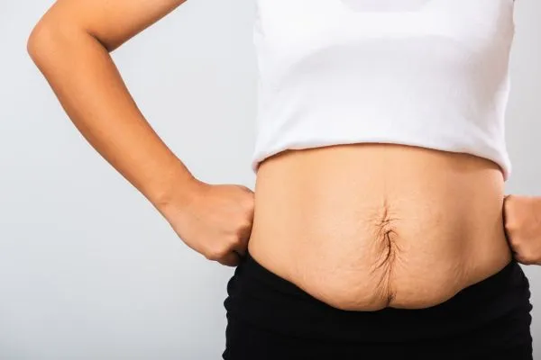 Image of a woman's stomach after weight loss with sagging skin following a gastric band Braintree
