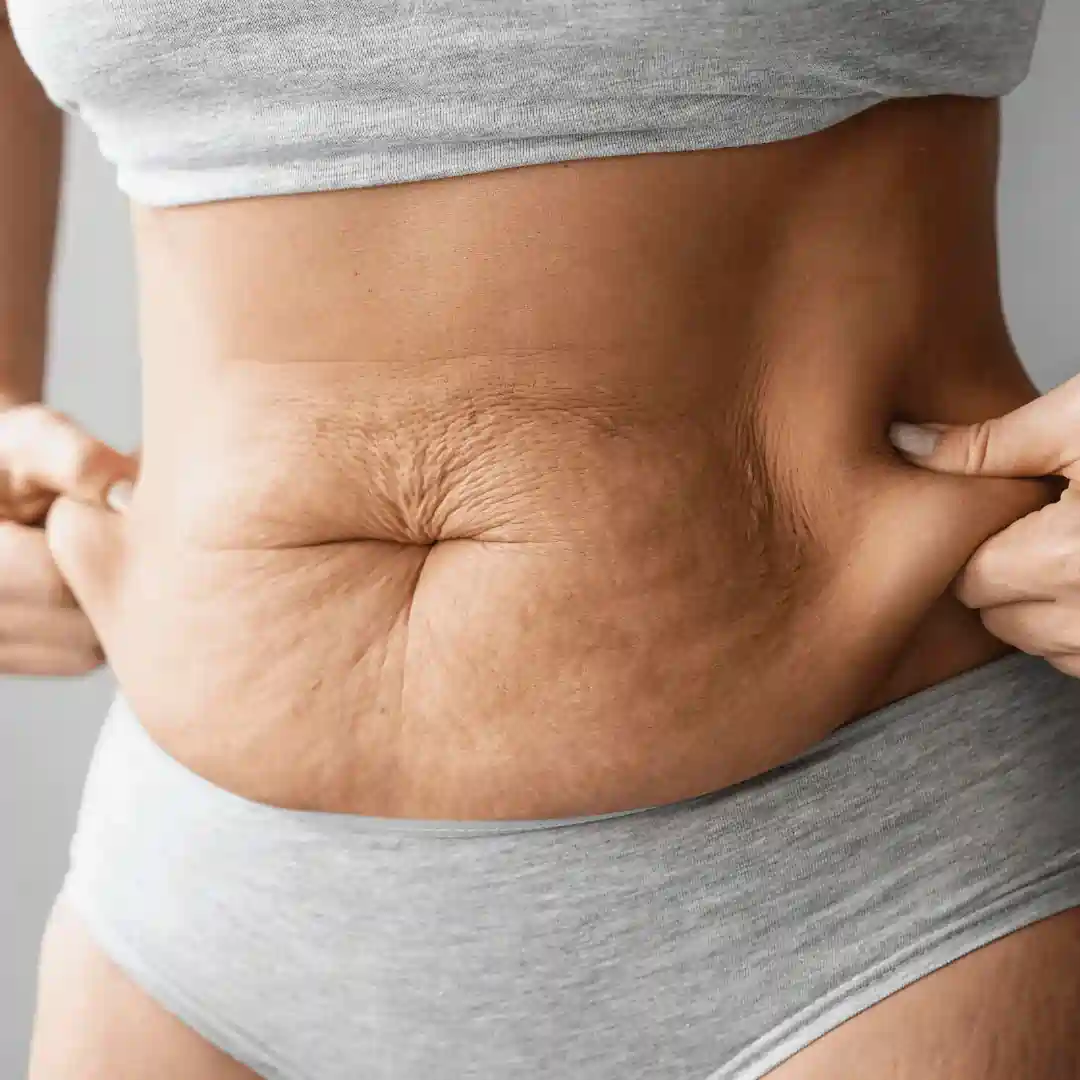 Is It Normal to Have Loose Skin After Pregnancy Braintree?