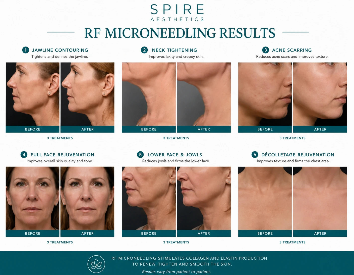 RF Microneedling Skin tightening Braintree results