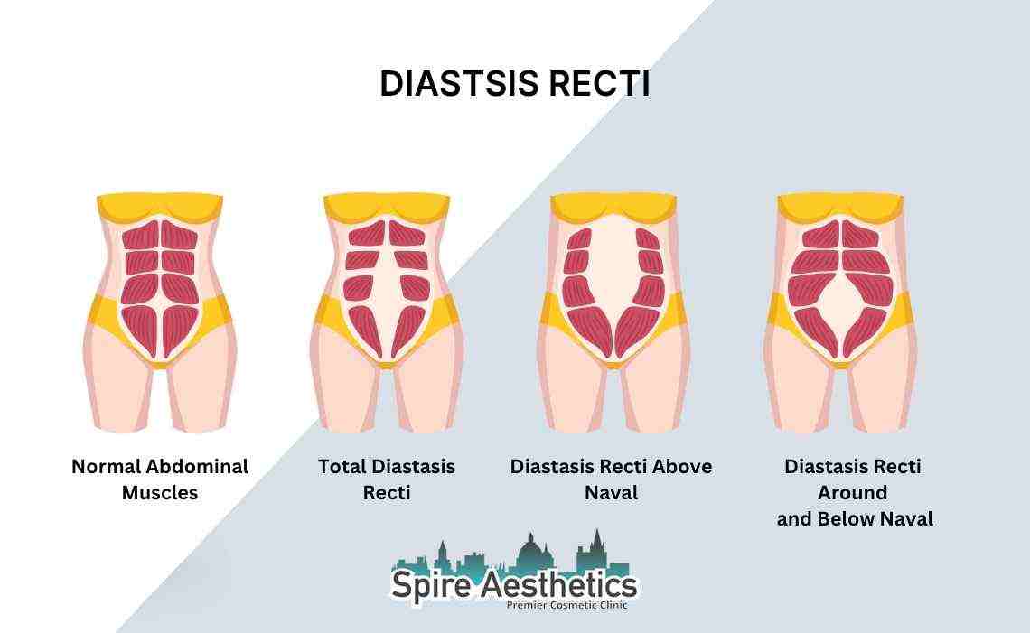 Is Non-Surgical Diastasis Recti Treatment Right for You? Common Concerns Answered Braintree